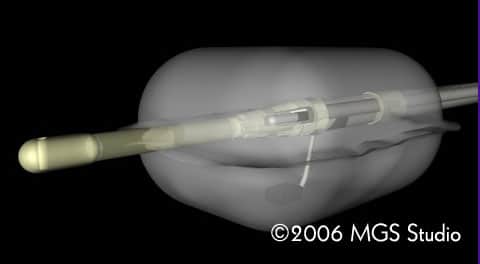 Figur 3. Ultralydprobe bygd inni kateteret som ligg sentralt i baggen, til bruk i øsofagus.