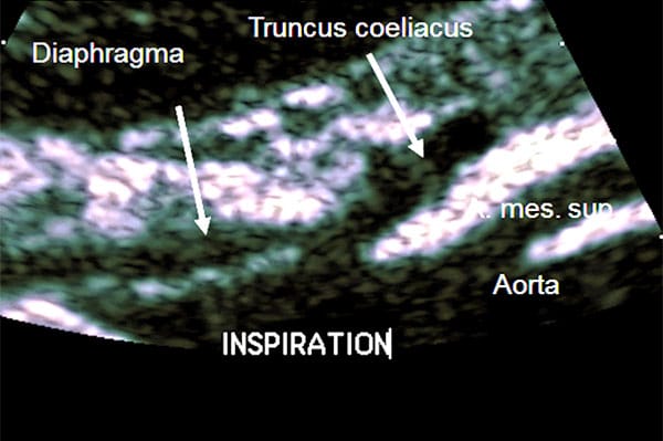 Figure 2. B-mode image of the longitudinal section of the abdominal aorta during inspiration demonstrating the release of the celiac trunk (right arrow) by the retracting diaphragm (left arrow).