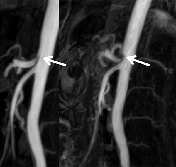 Figure 7. MR-Angiography in CGCS. Clearly visible increase of celiac trunk compression (arrows) from inspiration (left) to expiration (right).