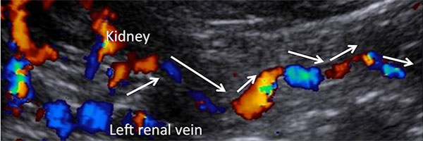Figure 8. Collateralization of the left renal vein: here via the left ovarian vein. Meandering course with inversed flow towards the left ovary. 