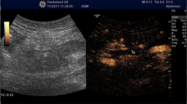 Figur 1. Adenocarcinom i pancreas. Bildet til venstre viser stor hypoekkogen tumor (Tu) i caput pancreatis med utløpere til omkringliggende vev. Bildet til hø.: Kontrastforsterket ultralyd viser en typisk hypovaskulær lesjon uten klare marginer. Bildene er fra en pasient som gjennomgår ultralyd sonoporasjon i kombinasjon med gemcitabin. Rundt tumor ses hypervaskulært omkringliggende pankreasvev. 