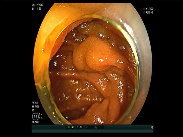 Bilde 1a: Endoskopisk bilde av varice i jejunum. 