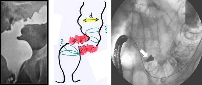 Figure 2: Planning a stent implantation according to configuration of the stenosis (a: X-ray, b: endoscopy). An intramural injection of contrast (Lipiodol®) exactly shows the target site (arrow).