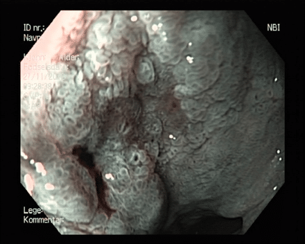 Suspekt område med NBI og eddik. Bilder viser uregelmessighet i tottemønster med «krater». Her viste biopsi HGD. 