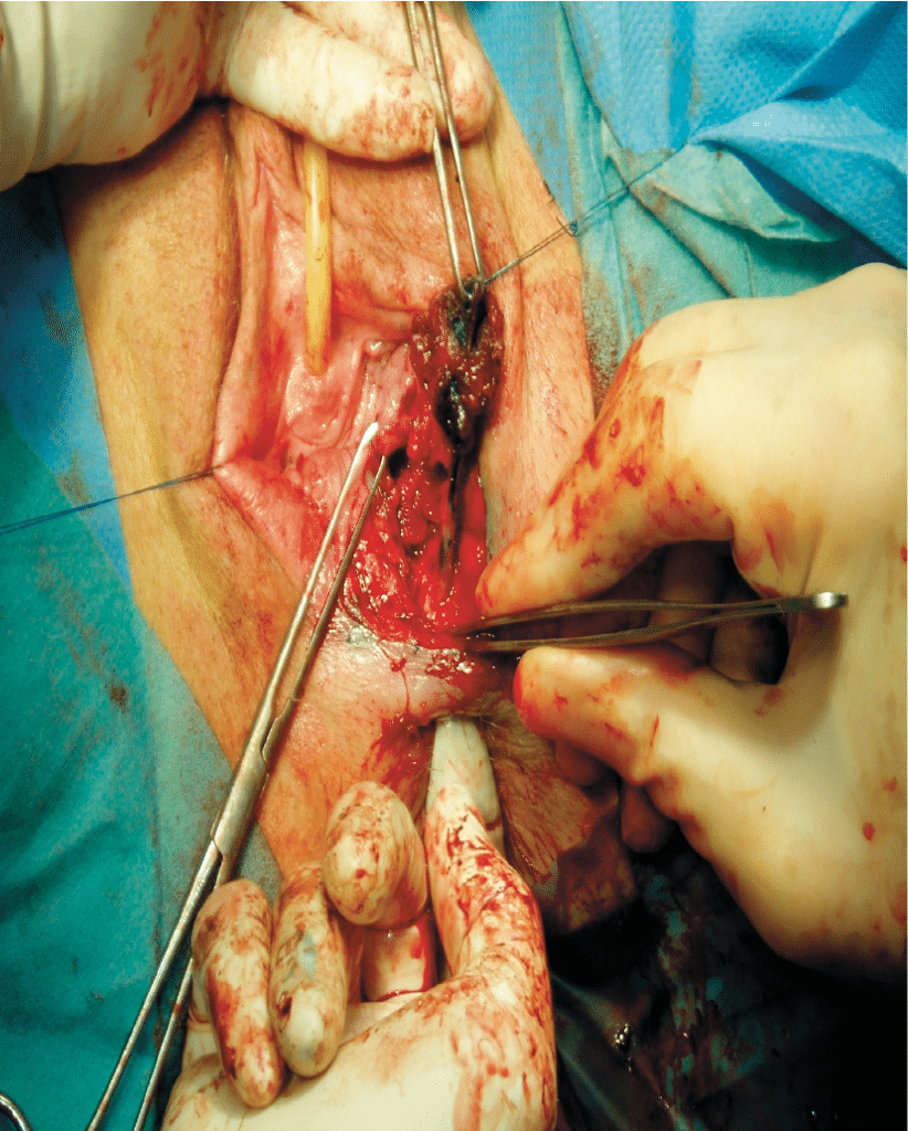 Figur 3. Fistelplastikk: Fistelgangen er dissekert ut, den er blå­farget pga. peroperativ methylenblått. Operatør palperer rektalt og fistel løses fra rektumveggen. Lagvis lukning fra rektum, ­rektovaginalspatiet og til slutt vaginalmukosa/perinealhud.
