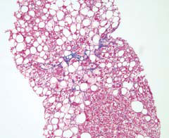 Haukeland-fig1-leverbiopsi