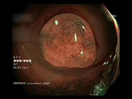 Lite-adenokarsinom-2