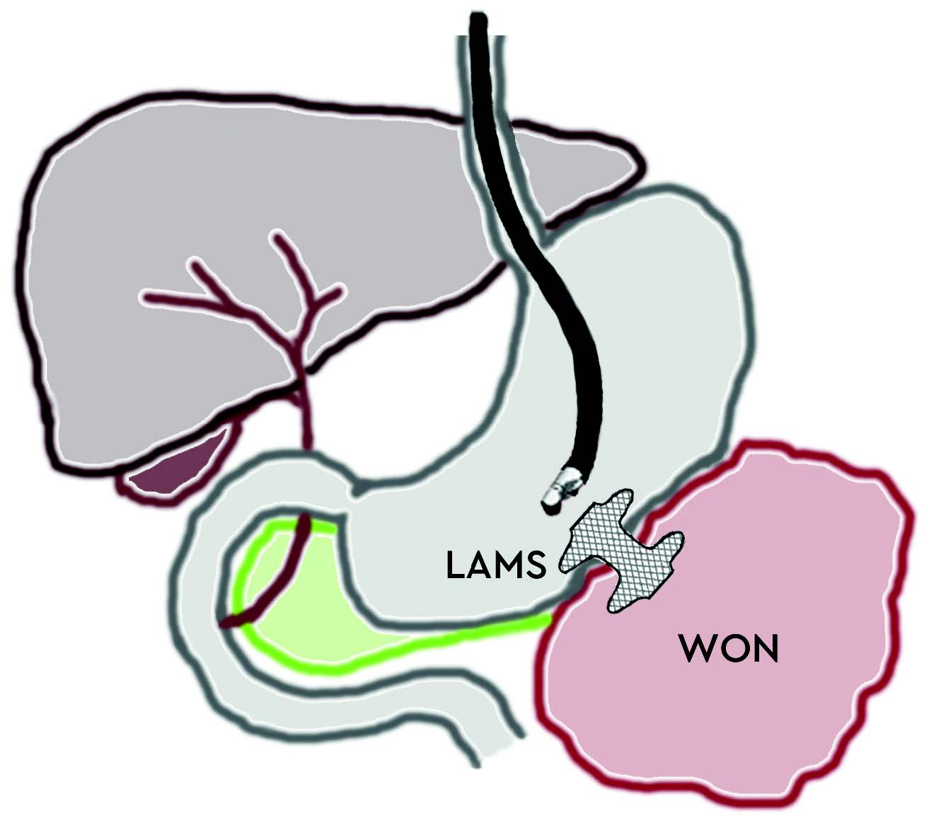 Endoskopisk behandling ved pankreatitt